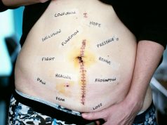 What everyone should know about C-sections