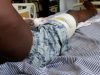 Stray bullet shatters bystander’s right leg in Wechiau clashes, MP demands swift justice