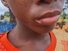 Mysterious illness leaves children struggling to walk, hear as Mafi Kope community appeals for urgent medical help